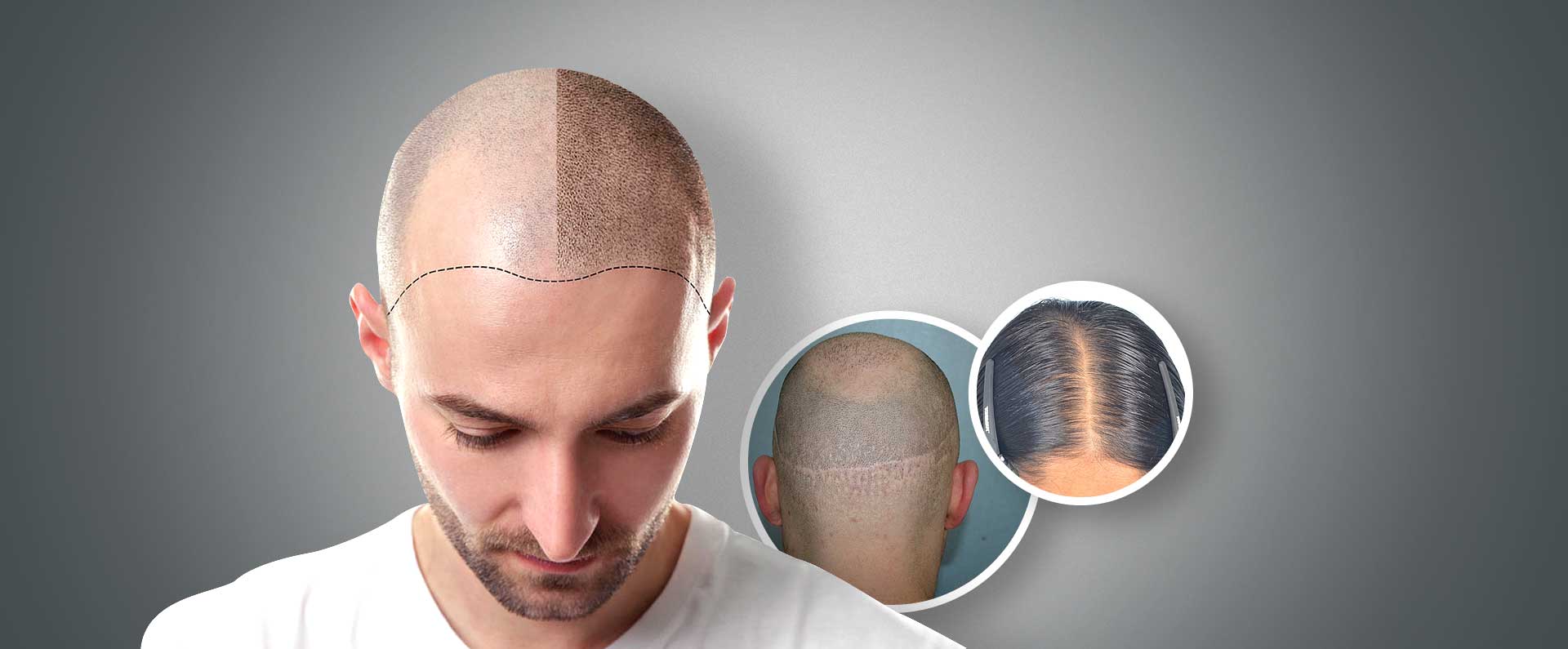 Ultimate Solution to Hairloss